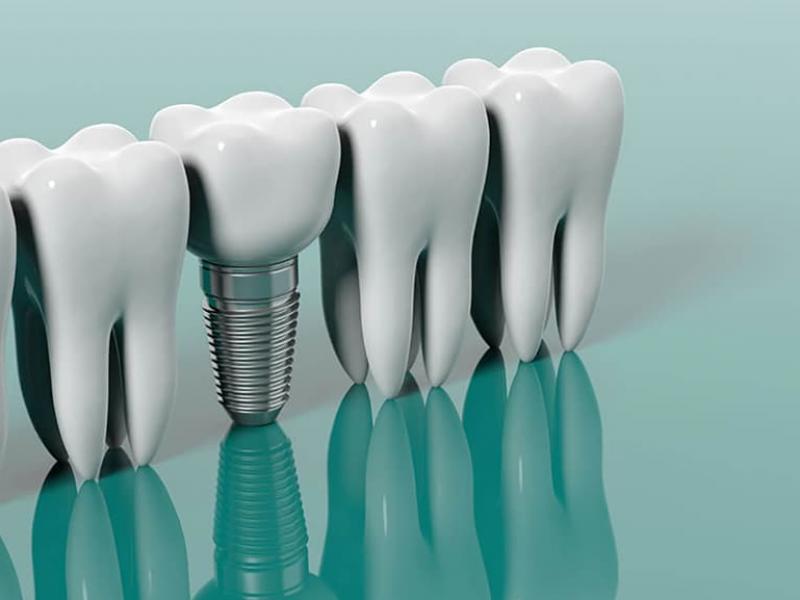преимущества имплантации зубов 