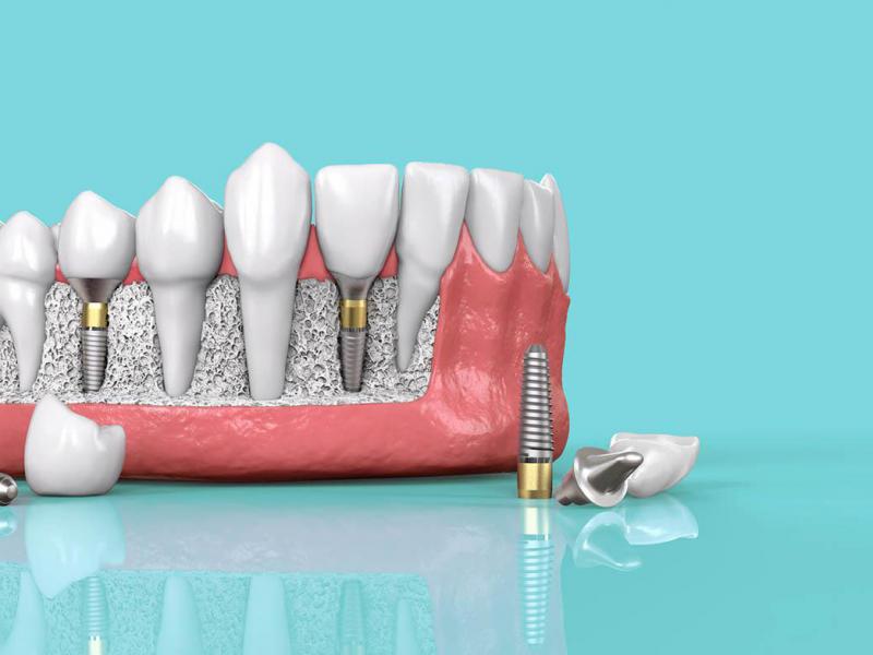преимущества имплантации зубов 